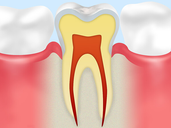 初期むし歯