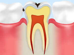 中期のむし歯