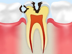 末期のむし歯