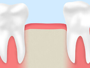 歯周病治療について