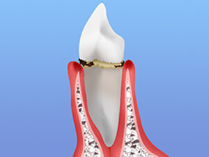 STEP 2：軽度歯周炎