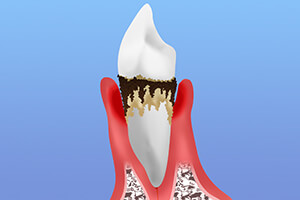 STEP 4：重度歯周炎