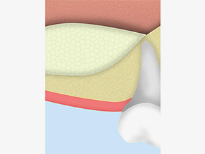 歯周外科手術（重度歯周病）