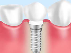 インプラントの特徴