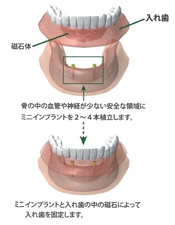 ミニインプラント