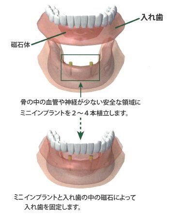 ミニインプラント