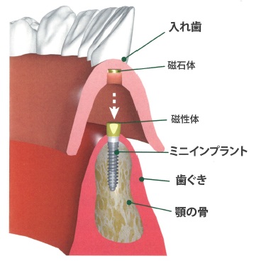 ミニインプラント構造