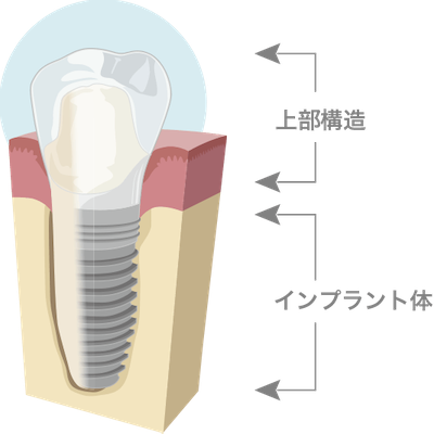 インプラント保証説明